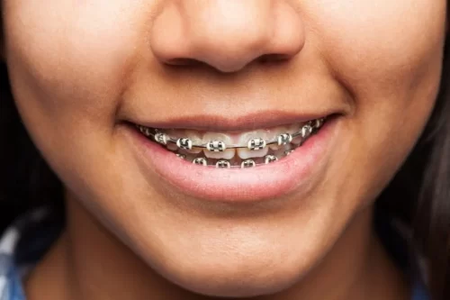 best-orthodontist-near-ttk-road-chennai
