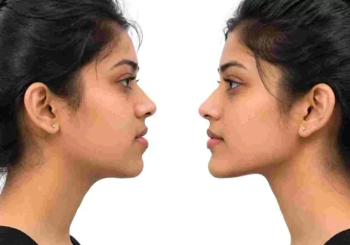 jaw-surgery-recovery-time-chennai