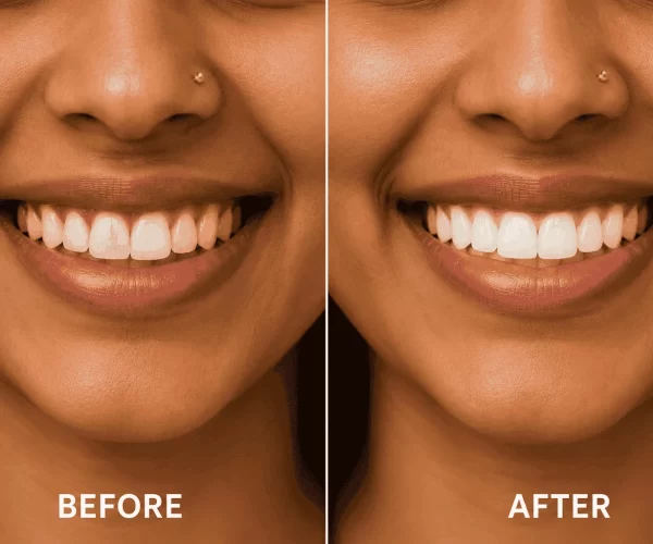 teeth-whitening-cost-chennai-clinic