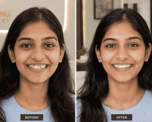 what-is-a-smile-makeover-chennai